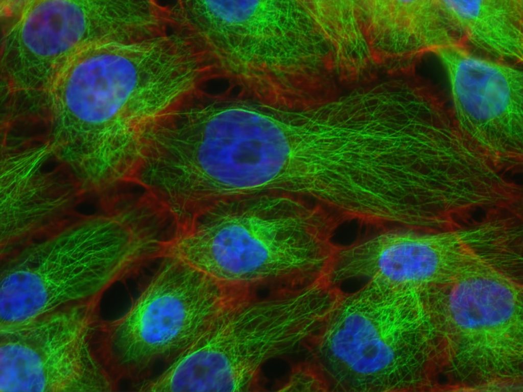breast cancer cells