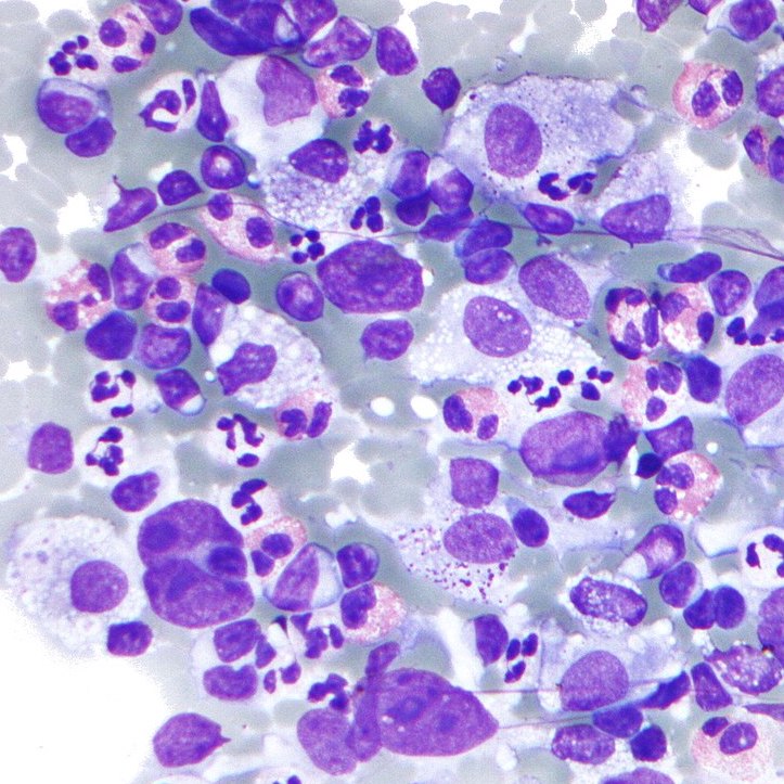 lymphoma