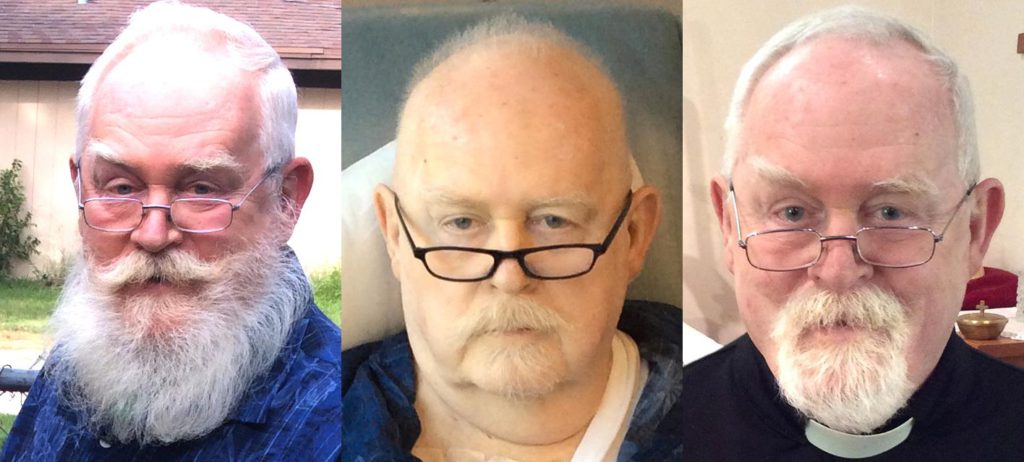 Before, during, and after chemo for DLBCL prior to CLL diagnosis