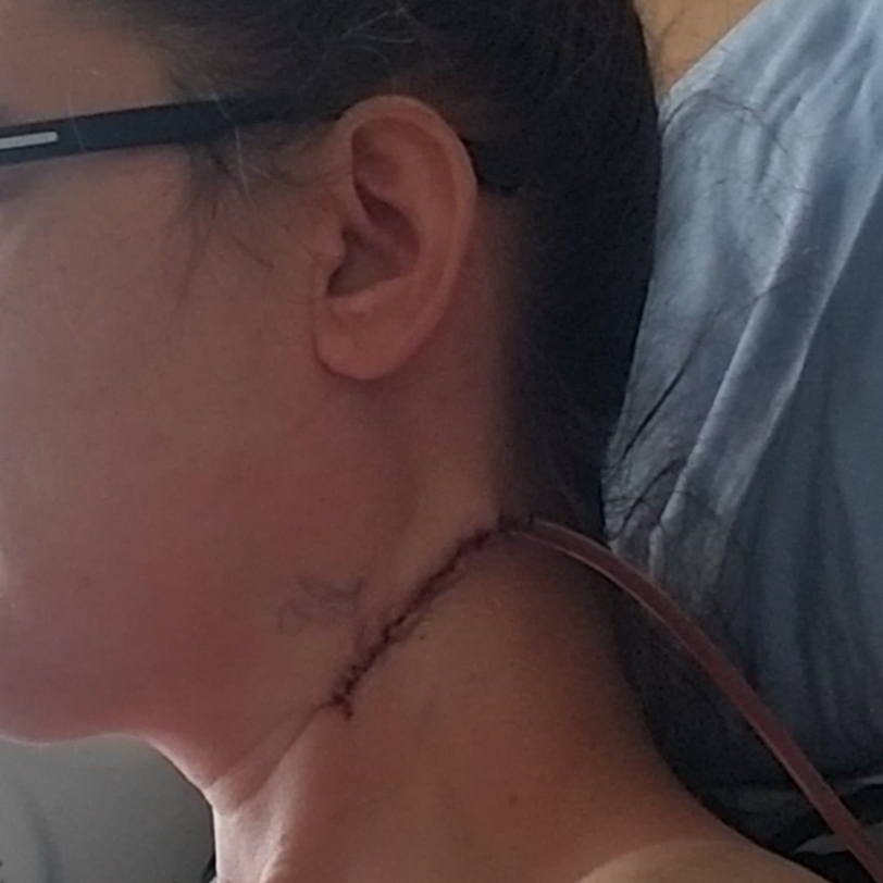 surgical biopsy scar