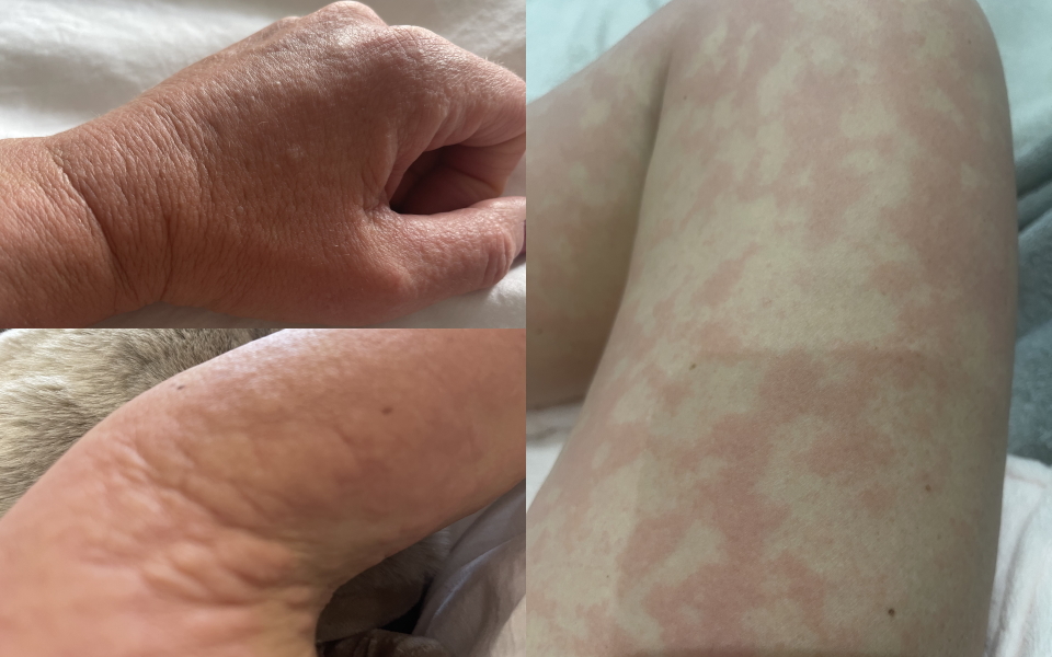 Tamsin W. allergic reactions