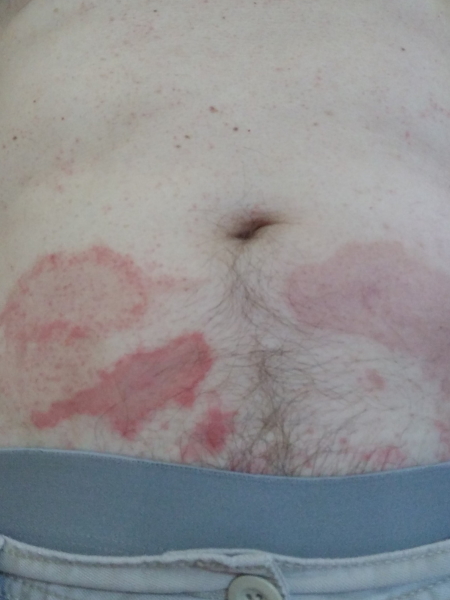 Ray H. rashes abdomen