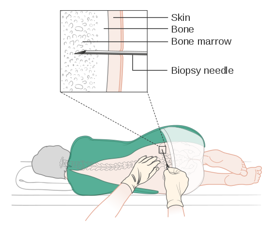 bone marrow biopsy
