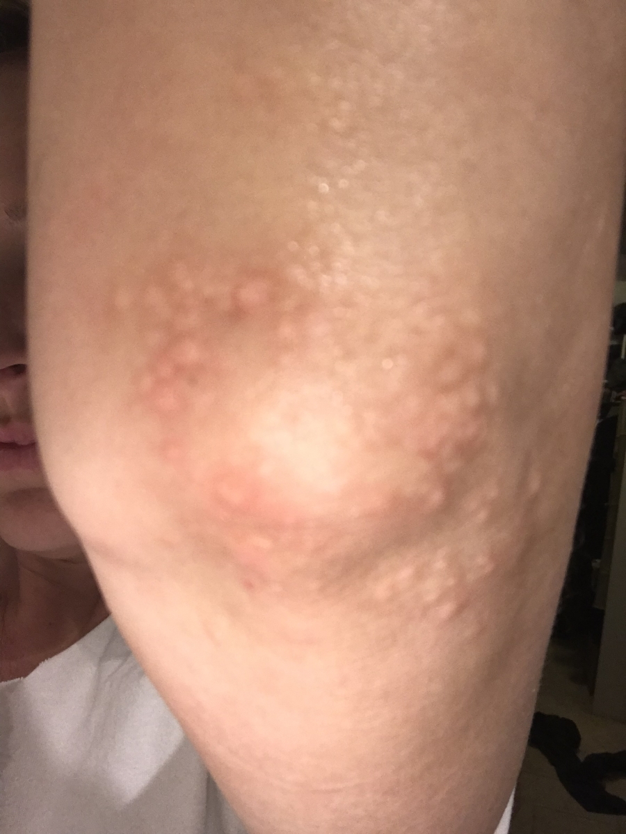 Samantha S. Brentuximab more rash
