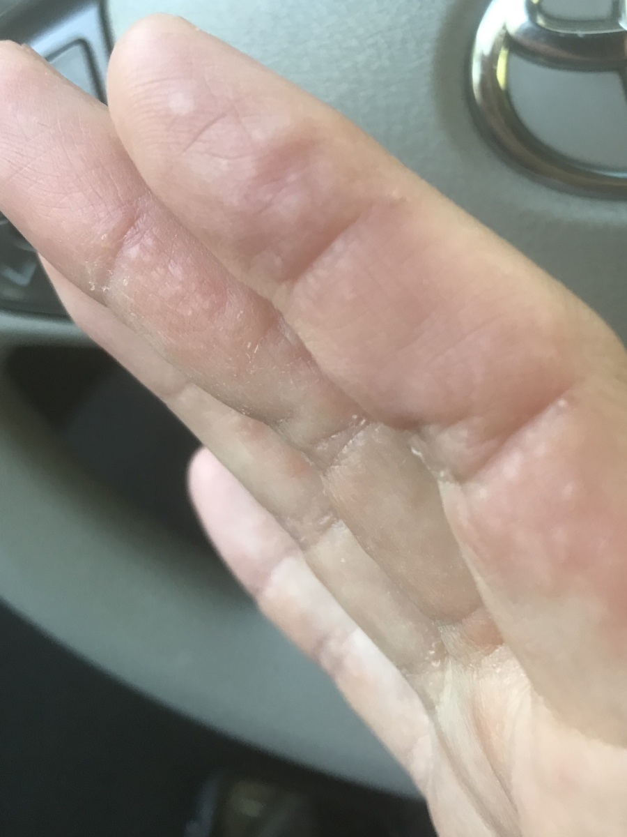 Samantha S. Brentuximab rash fingers