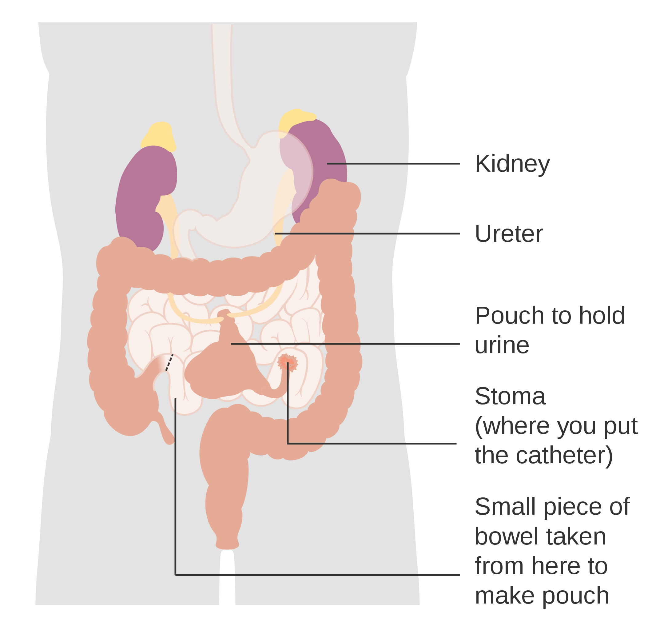 Diagram showing a continent urinary diversion CRUK