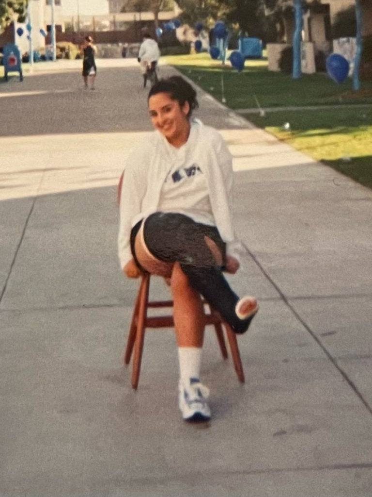 Renee F. leg in cast