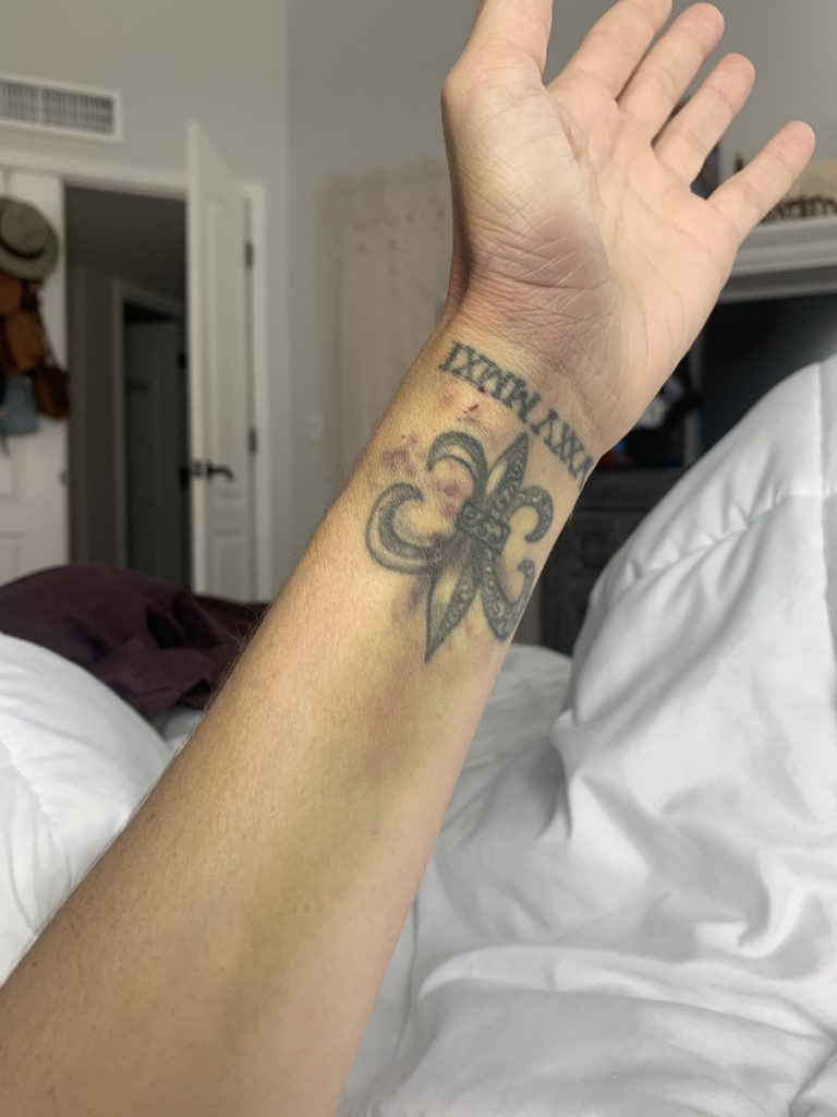 Amy H. arm bruise