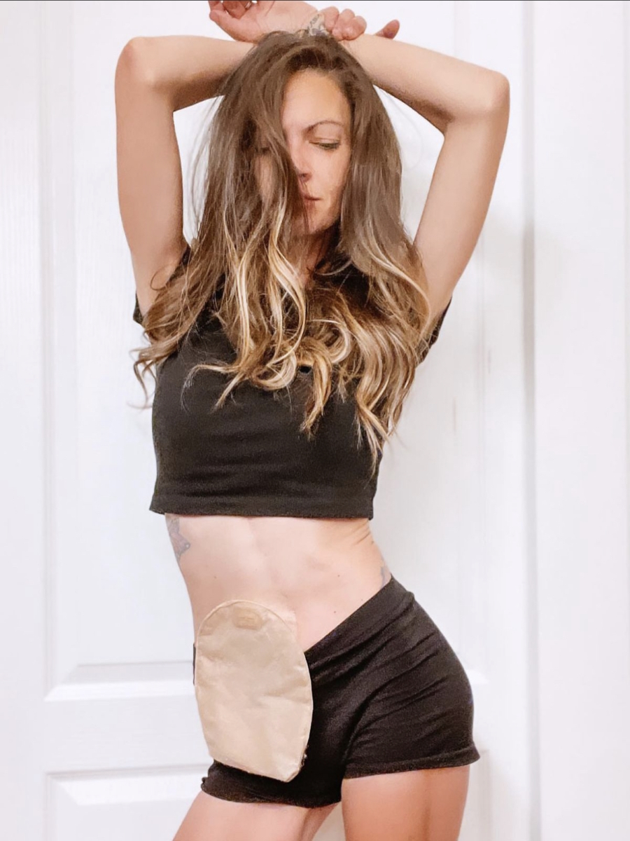 Amy H. ostomy bag