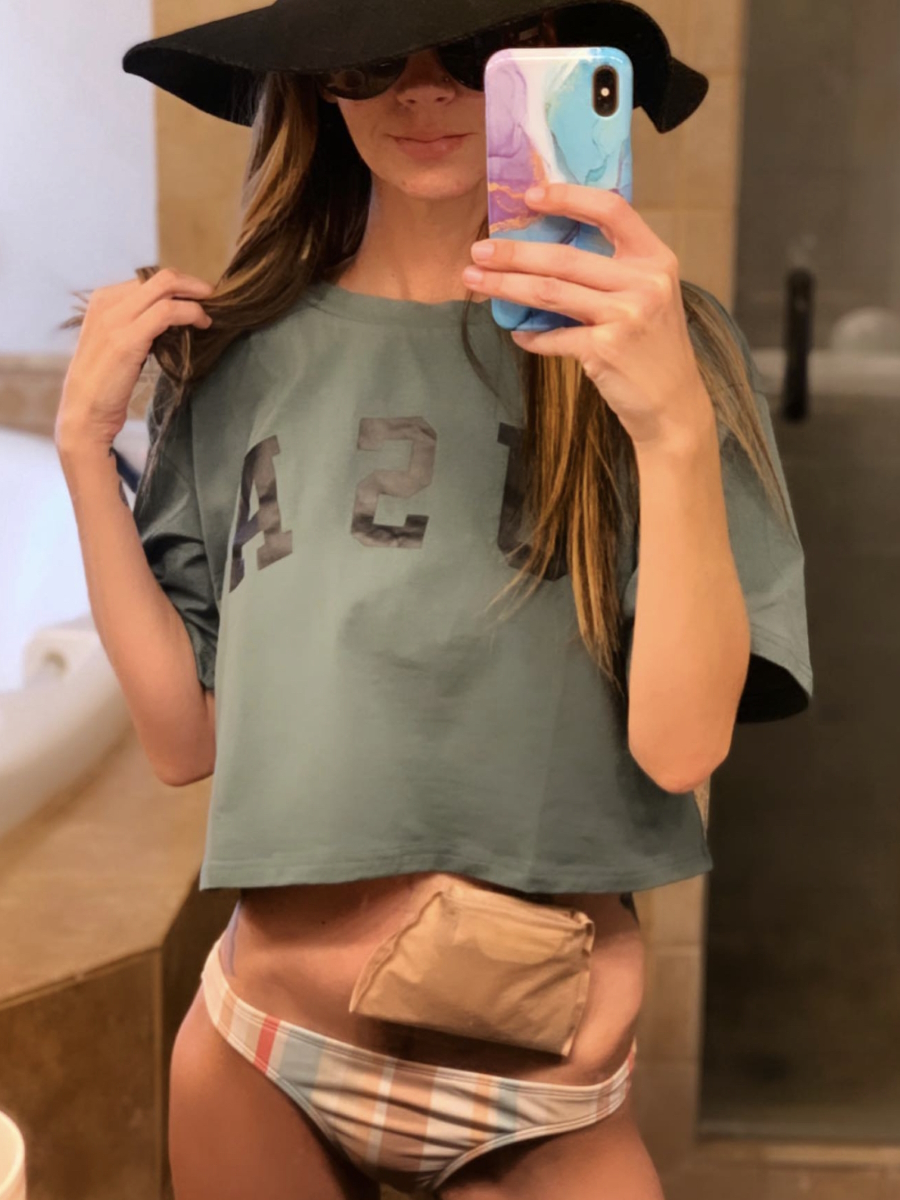 Amy H. ostomy bag
