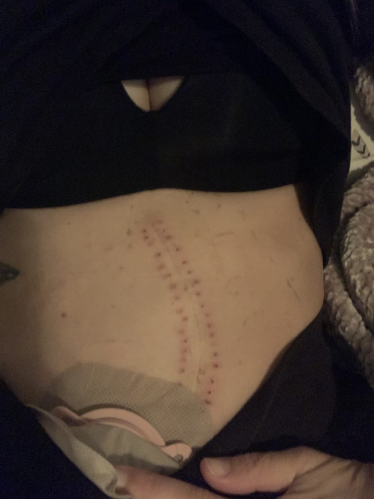 Amy H.'s stage 3B Rectal Cancer surgery scar.