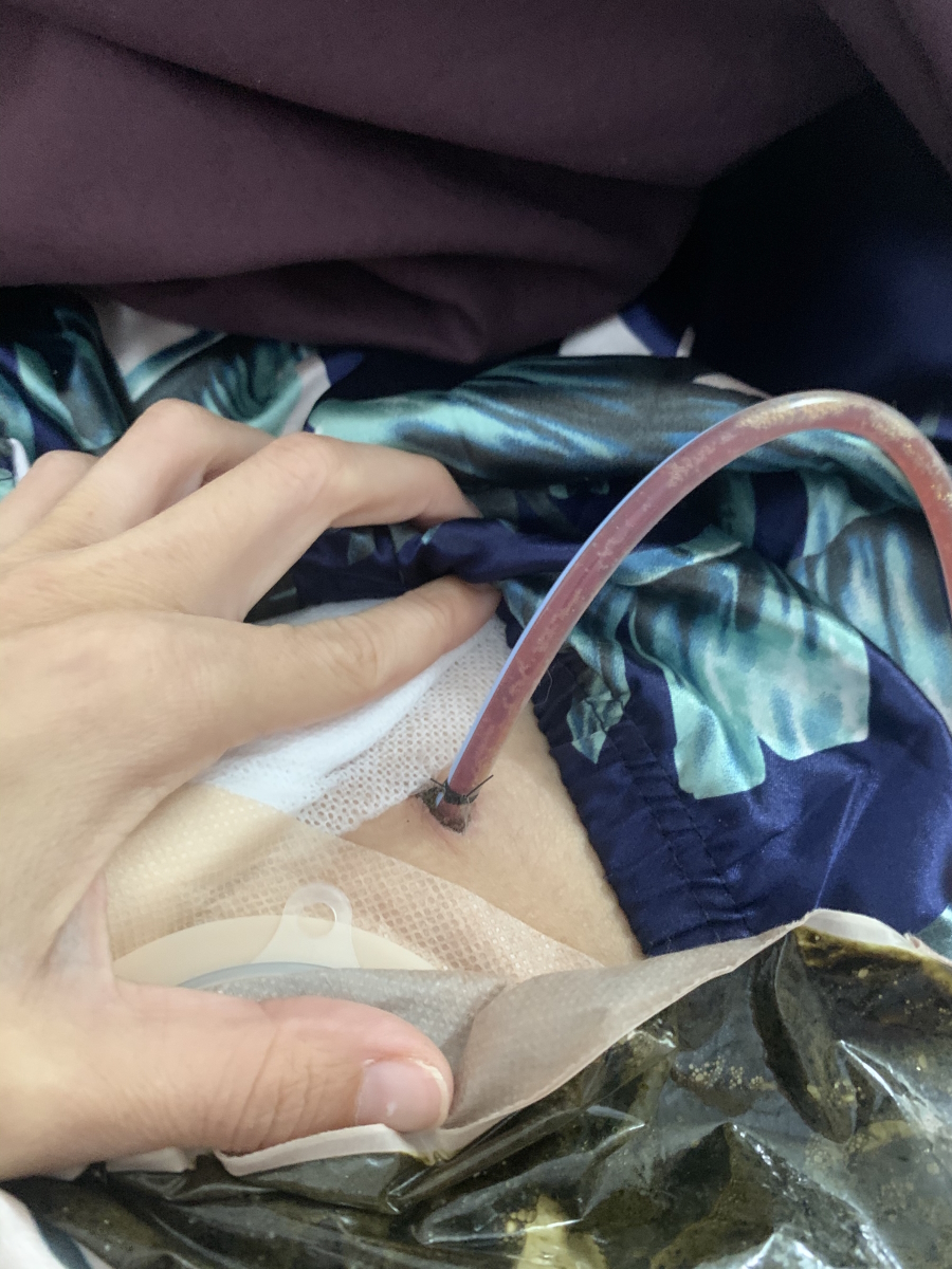 Amy H. surgery
