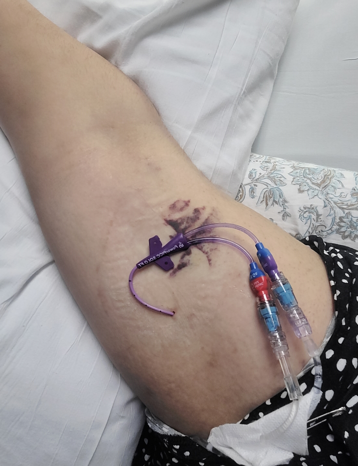 Tatijane W. PICC line