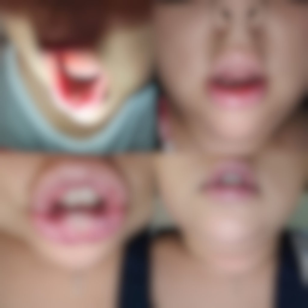 Tatijane W. mouth sores