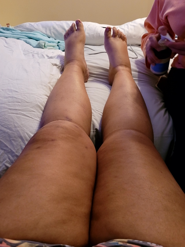 Tatijane W. treatment