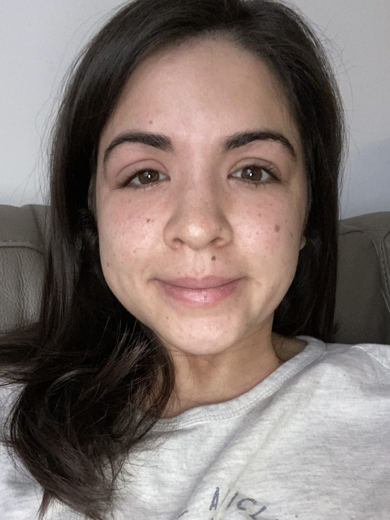 Stephanie V. swollen eye