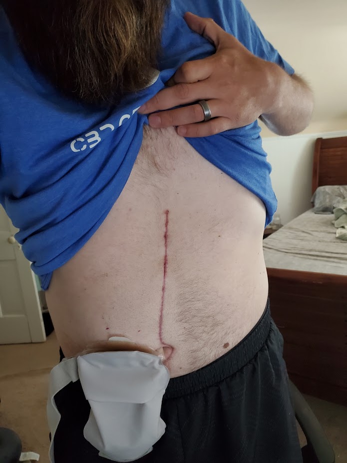 There are several types of ostomy bags to choose from