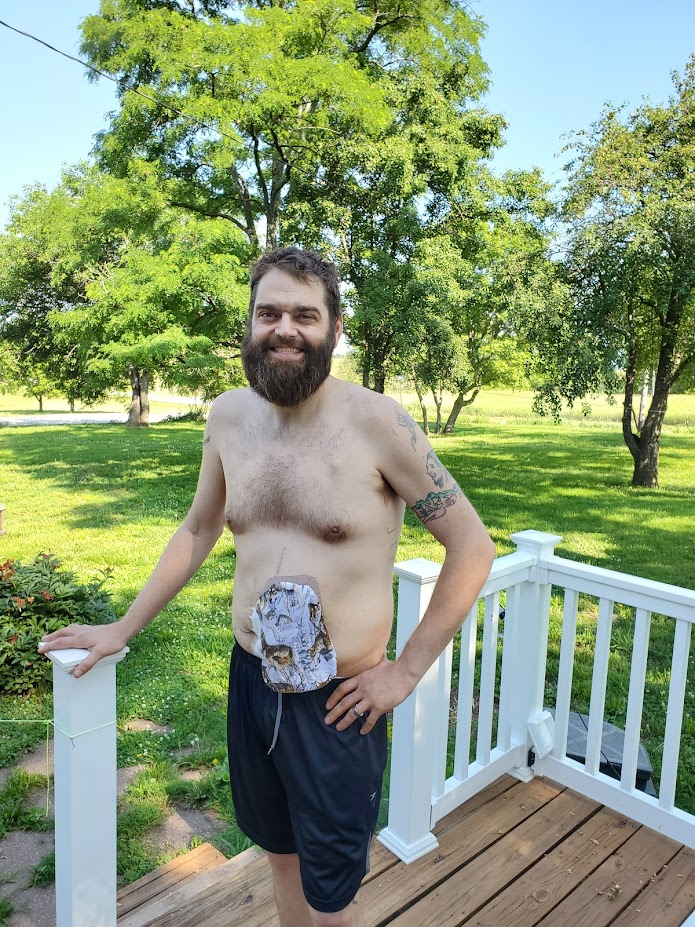 Jason's had success with both colostomy and ileostomy bags